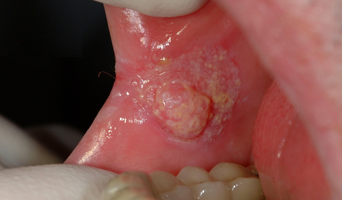 علائم ابتلا به سرطان دهان