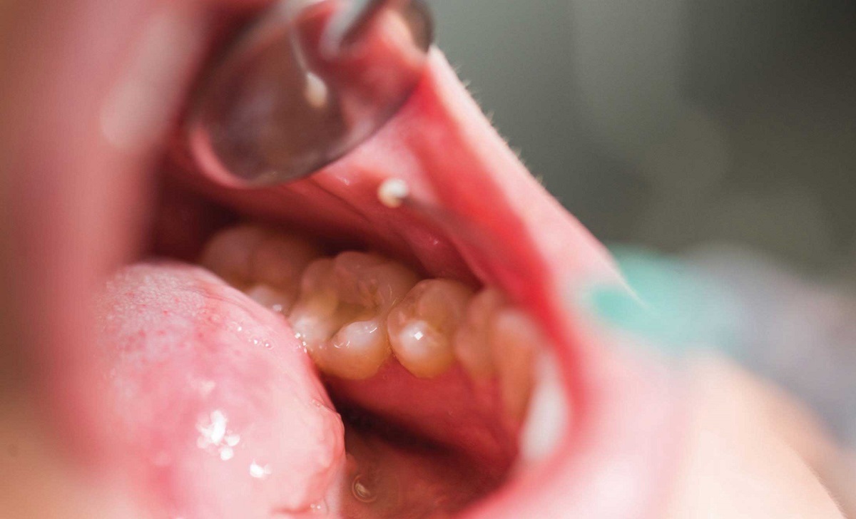 علائم ابتلا به سرطان دهان