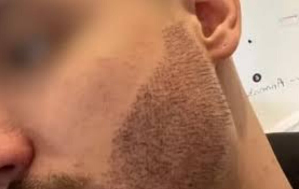 خودکشی به خاطر بد شدن کاشت ریش در استانبول + عکس خودکشی به خاطر بد شدن کاشت ریش در استانبول + عکس