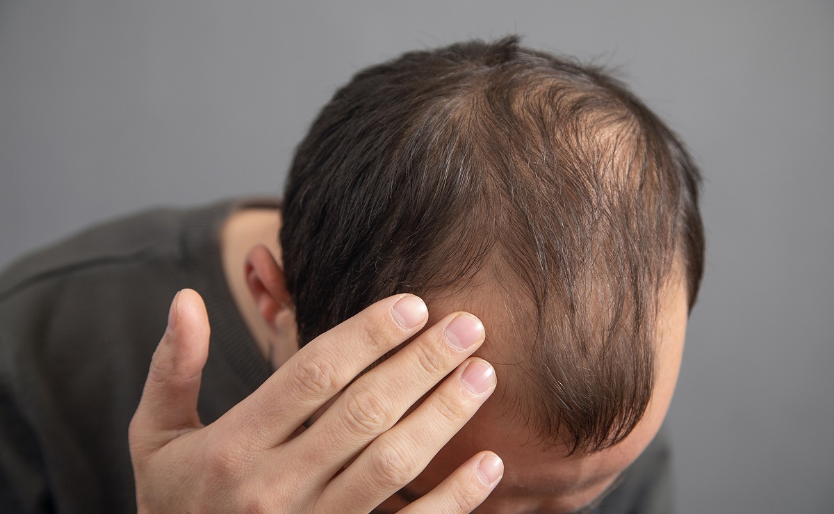 بهترین راهها برای جلوگیری از ریزش مو بهترین راهها برای جلوگیری از ریزش مو