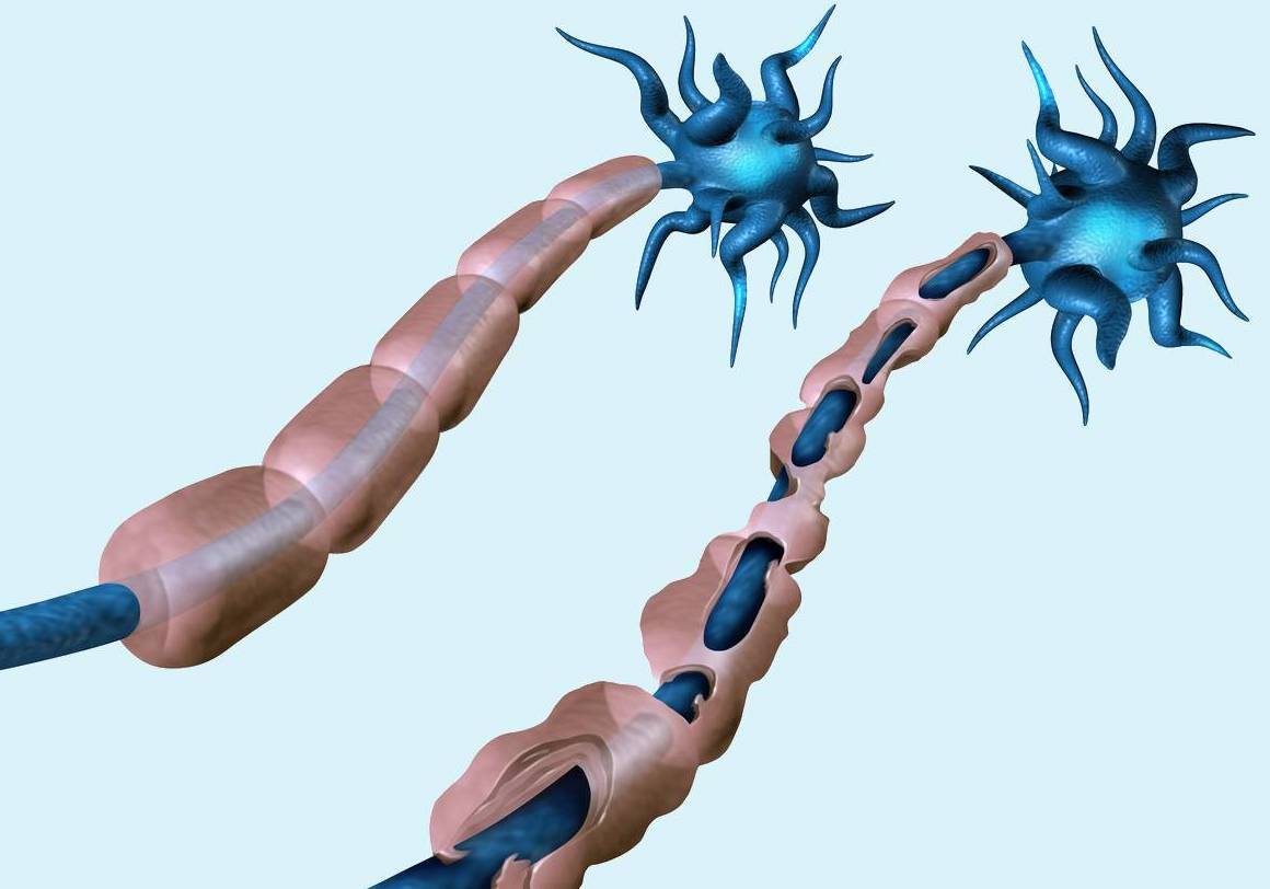 بیماری ام اس چیست و راههای درمان آن کدامند؟ بیماری ام اس چیست و راههای درمان آن کدامند؟