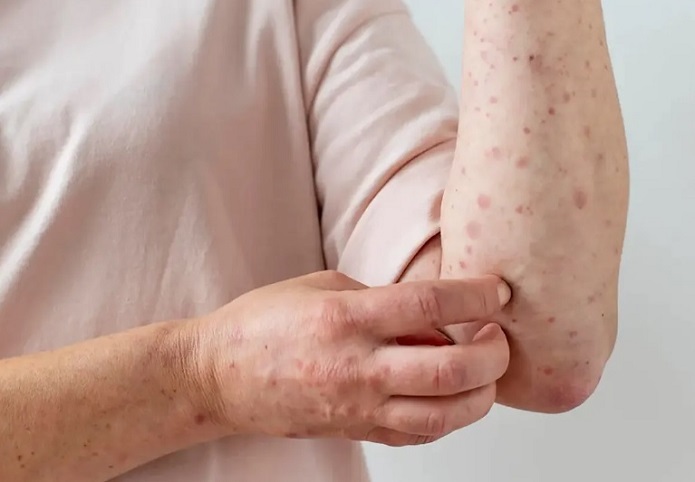 همه آنچه باید درباره آبله مرغان بدانیم همه آنچه باید درباره آبله مرغان بدانیم