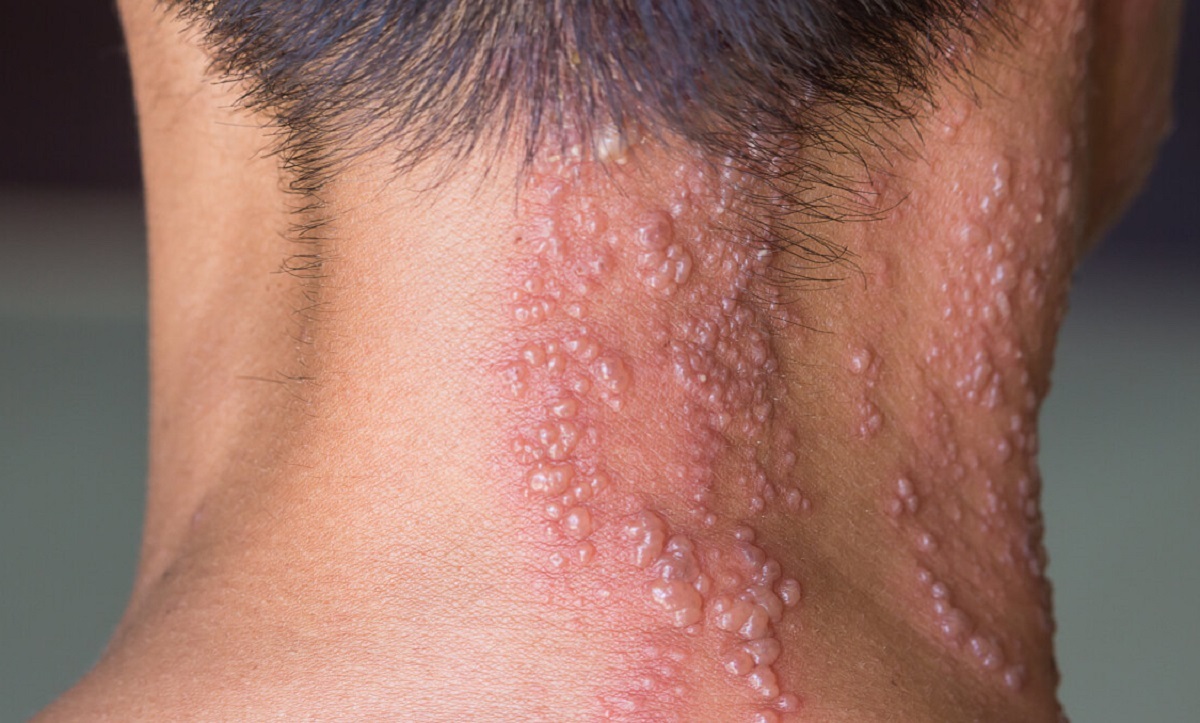 همه آنچه باید درباره بیماری زونا بدانیم