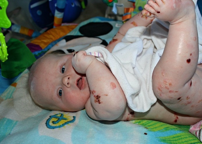 همه آنچه باید درباره بیماری EB بدانیم