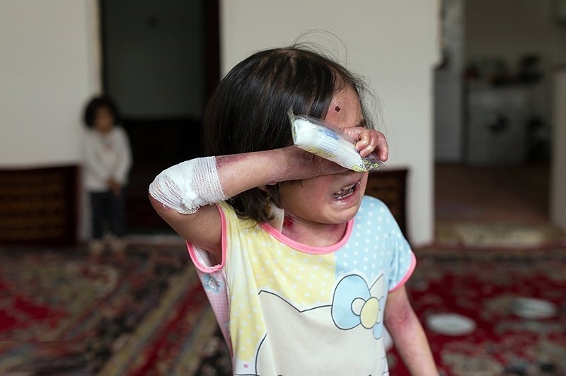 همه آنچه باید درباره بیماری EB بدانیم