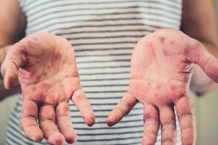 همه آنچه باید درباره بیماری EB بدانیم