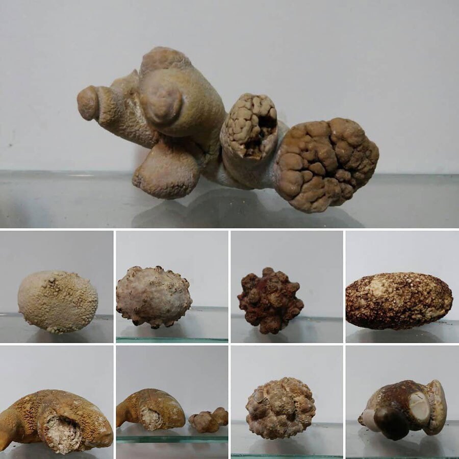 علائم و نشانههای سنگ کلیه چیست؟ علائم و نشانههای سنگ کلیه چیست؟