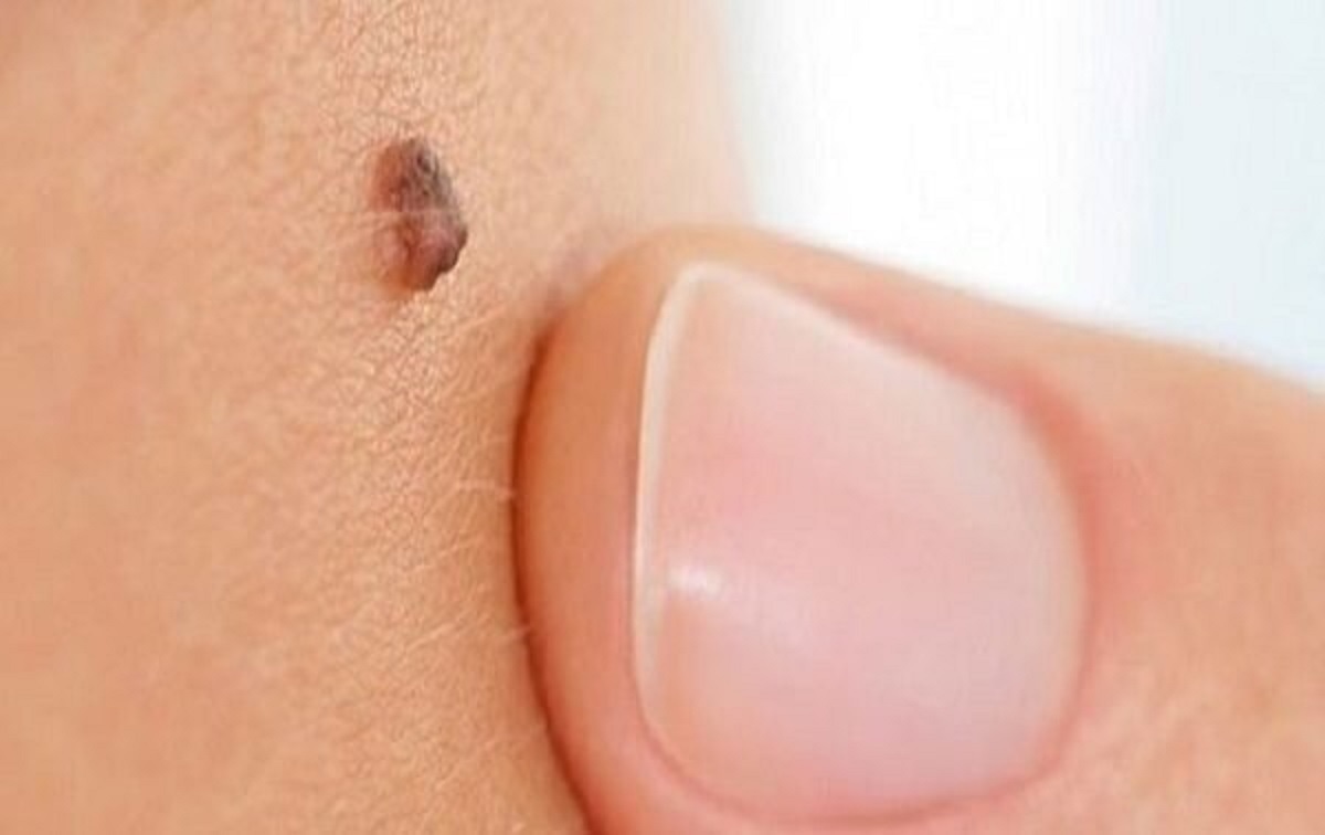 علائم مهم خال سرطانی