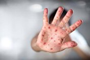 همه آنچه باید درباره آبله مرغان بدانیم