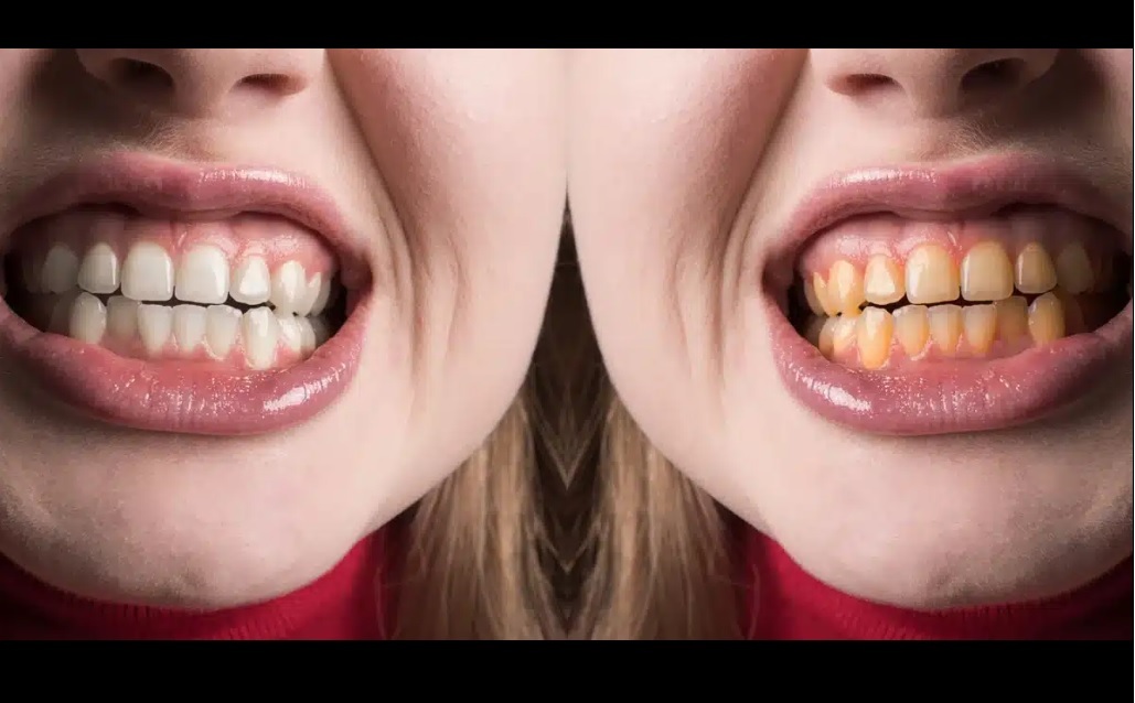 راههای سفید کردن دندان راههای سفید کردن دندان