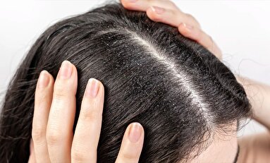 عادت‌ نادرستی که باعث شوره‌ سر می‌شوند